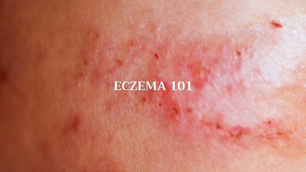 Eczema 101