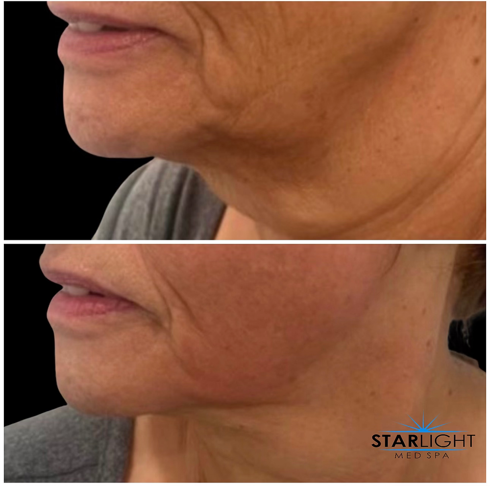 FORMA – The Ultimate Skin Tightening Treatment in Vaughan
