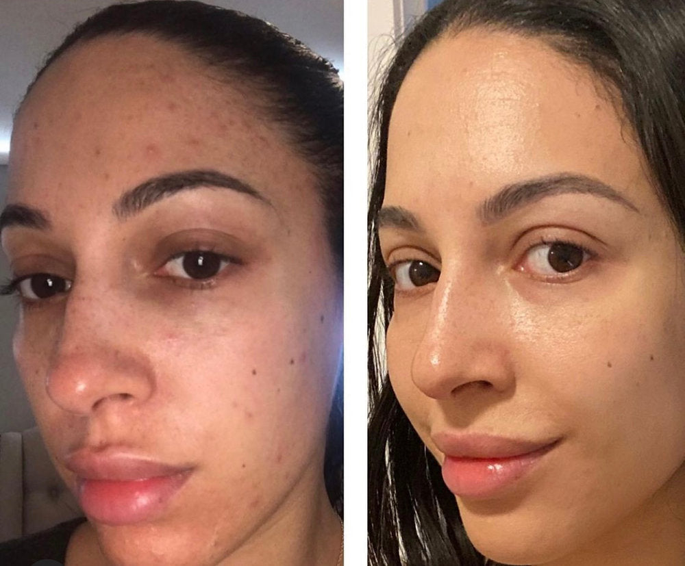A Hormonal Acne Success Story!