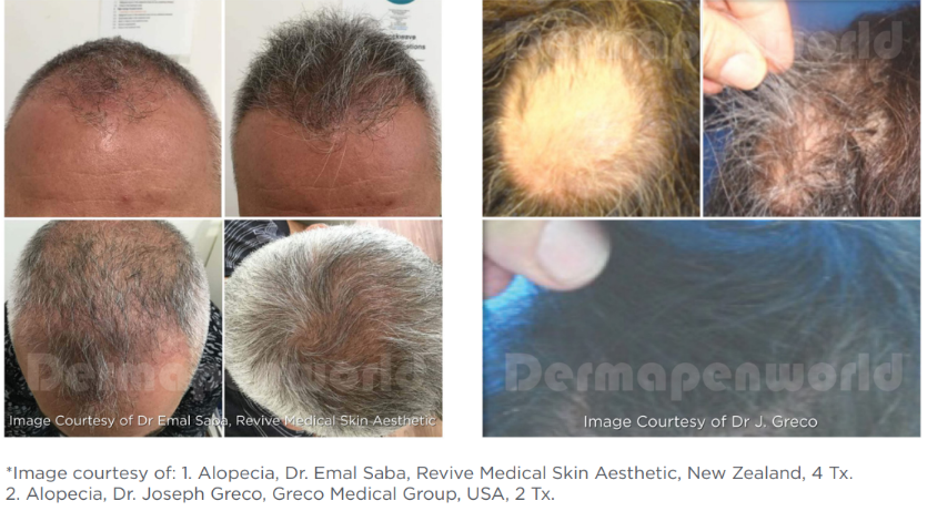 🌟 How Exosomes Are Transforming Hair Loss Treatments at Starlight Med Spa
