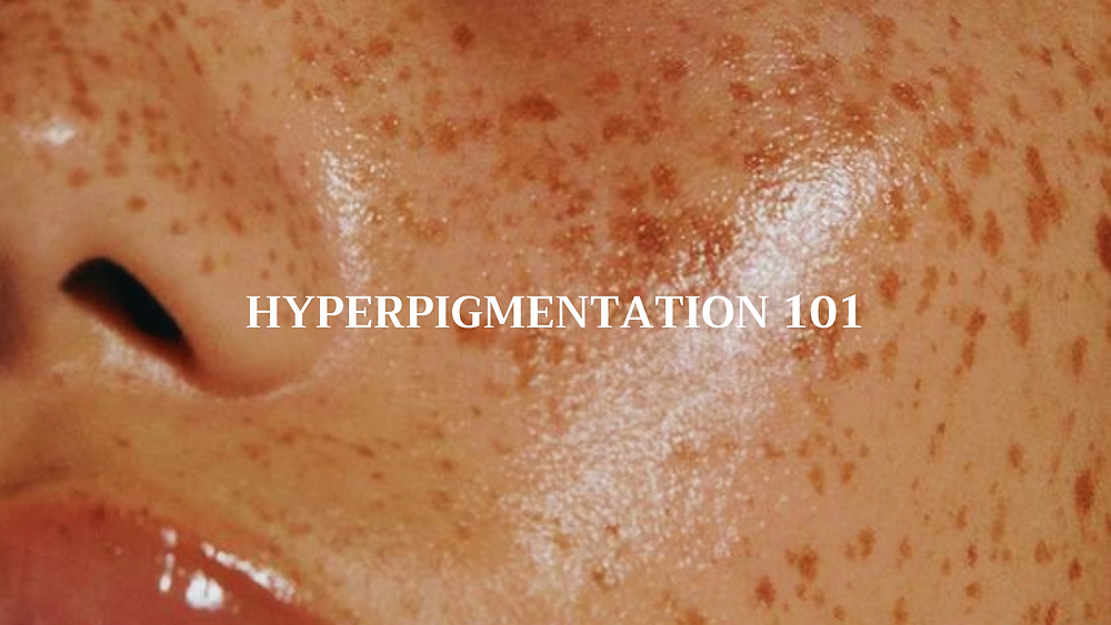 Hyperpigmentation 101
