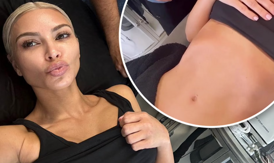 Morpheus8: The Ultimate Skin Remodelling Loved by Kim Kardashian and Celebrities Everywhere