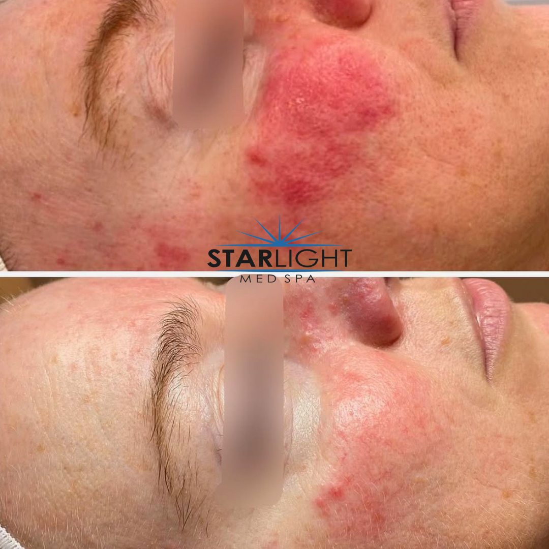 Rosacea Goodbye- Managing Facial Redness Long-Term