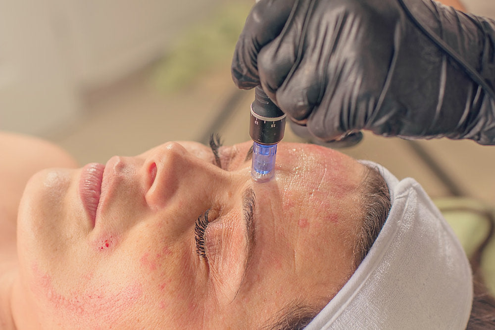 Treatment For Acne Scarring: How Does Microneedling Work?