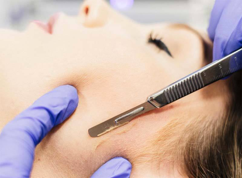 Why Laser Makes You Breakout- Before it Makes your Breakouts Stop!