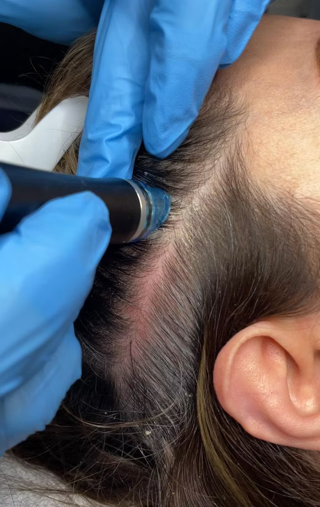 Keravive Hydrafacial