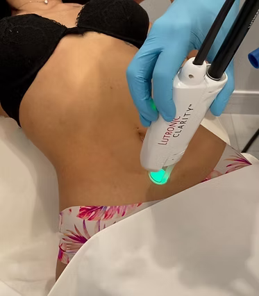 Laser Hair Removal - Medium Areas