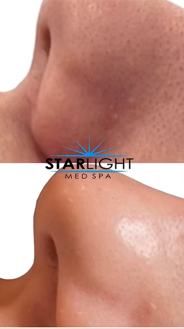 HYDRAFACIAL MD®