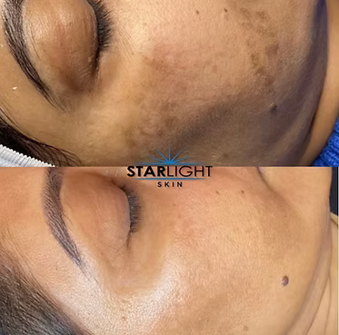 MICRONEEDLING