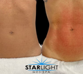 Starlight Body Contouring - 30 Mins