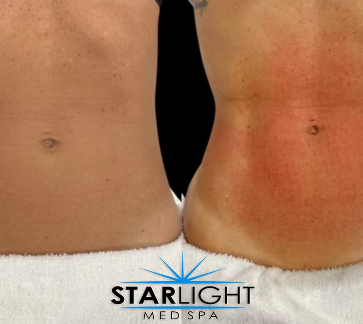 Starlight Body Contouring - 45 Mins
