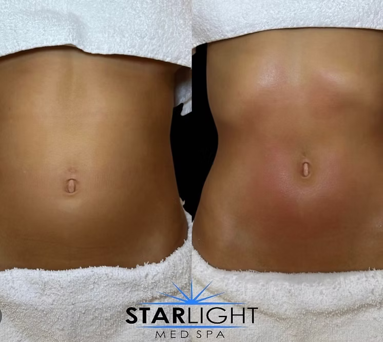 Starlight Body Contouring - 45 Mins