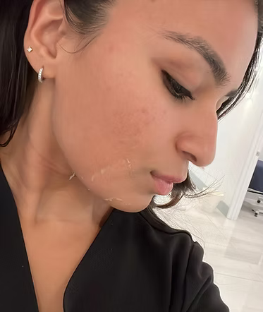 Green Peel
