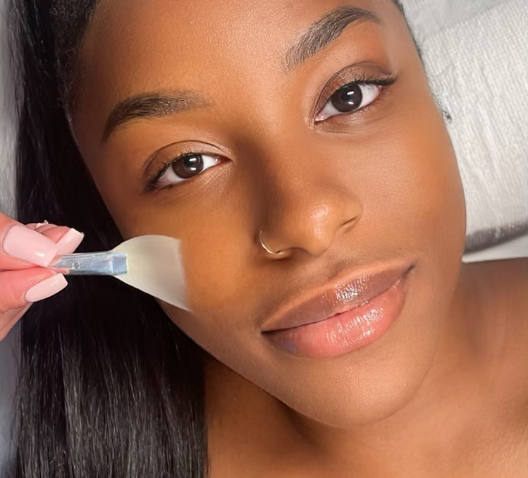 Chemical Peels