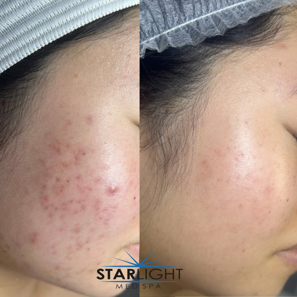 Before and after Acne Treatment