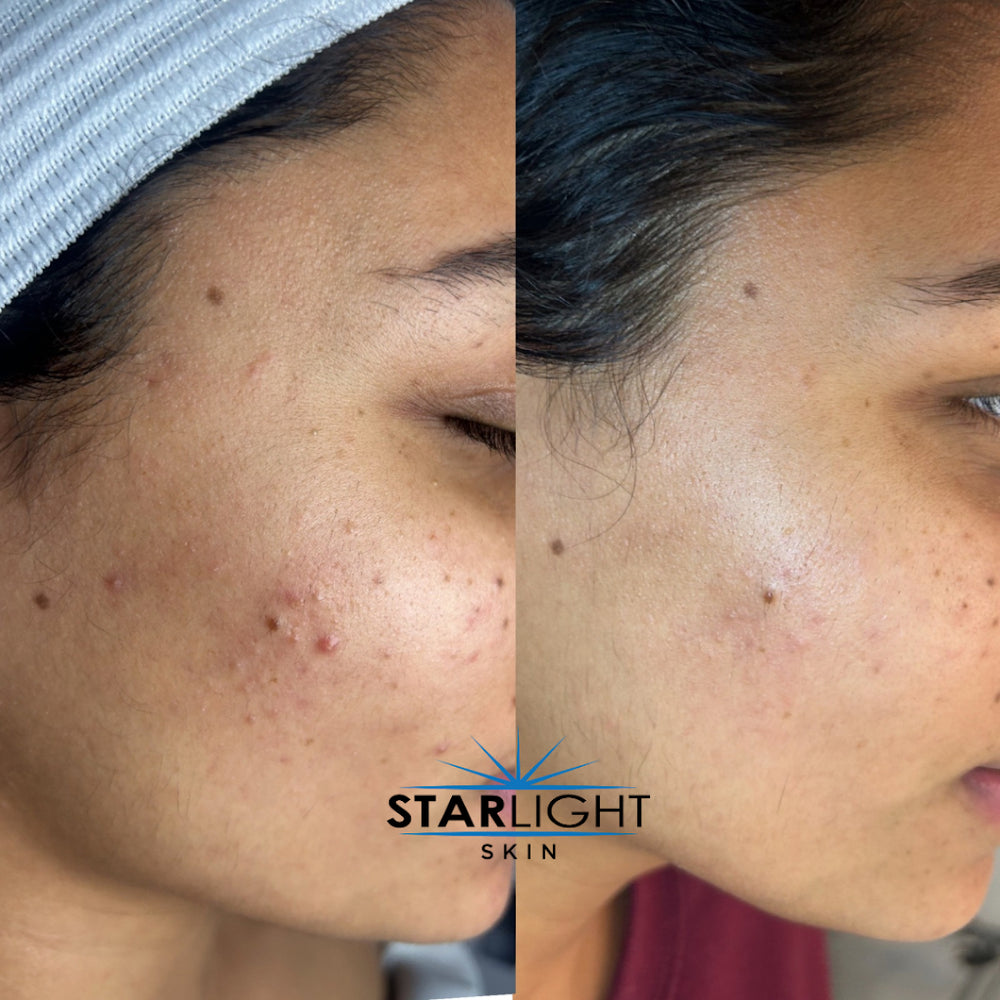 Before and after Skin Rejuvenation