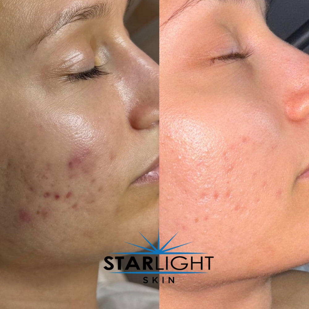 Before and after Scar Treatment