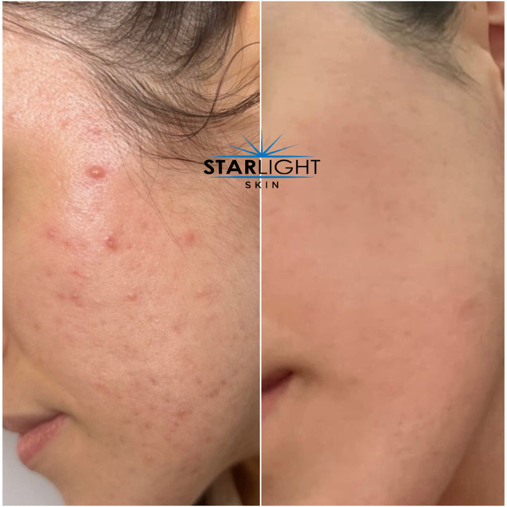 Before and after Pigmentation Treatment