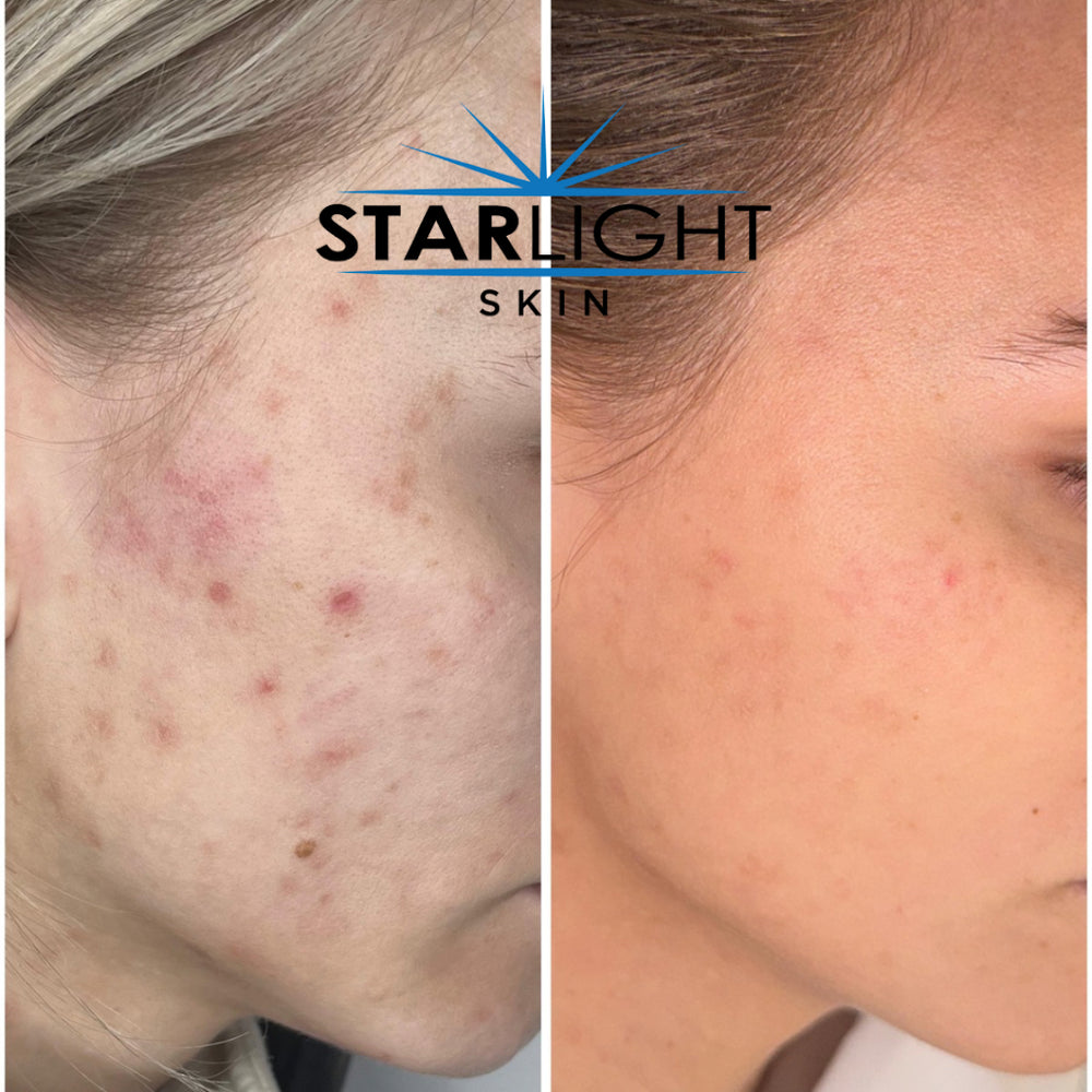 Before and after Skin Improvement