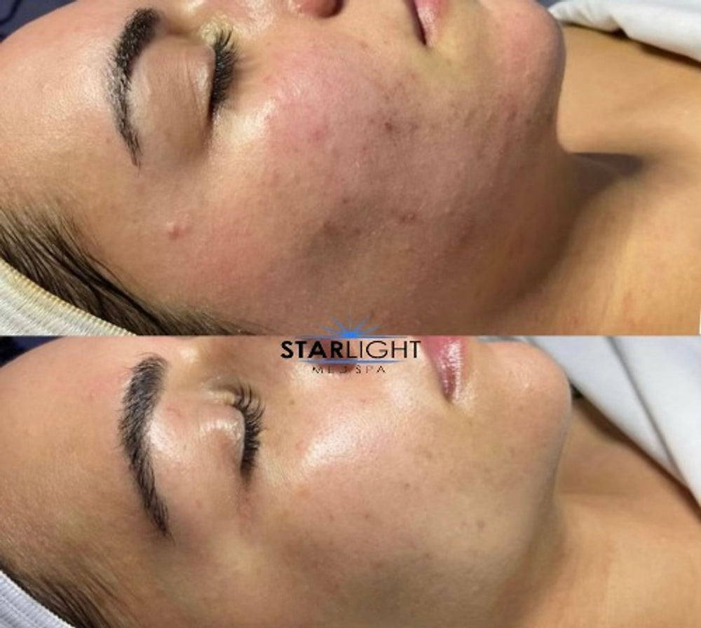 Before and after Skin Clarity
