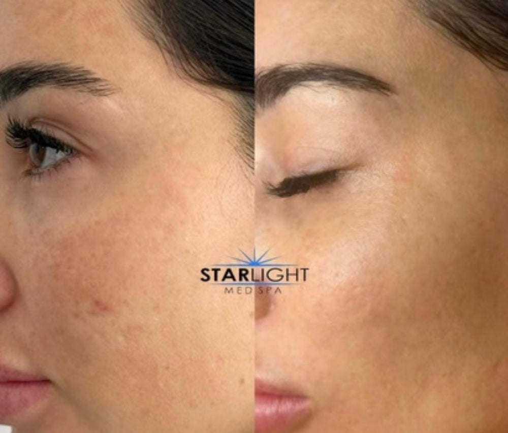 Before and after Pigmentation & Texture