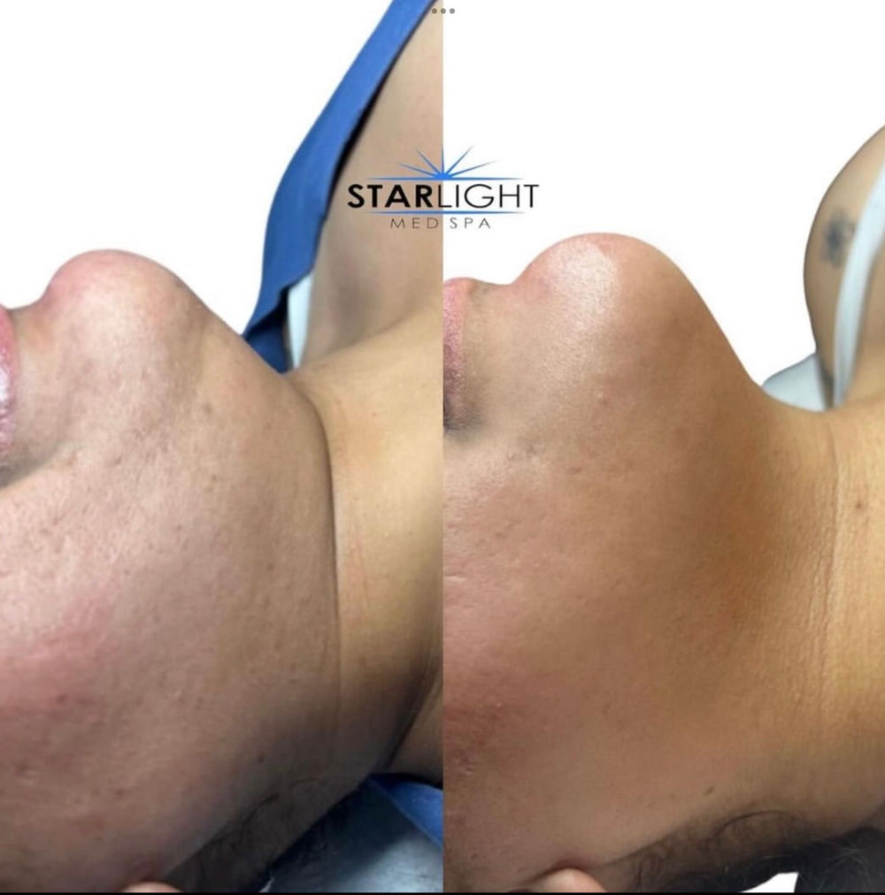 Before and after Jawline Skin Refinement