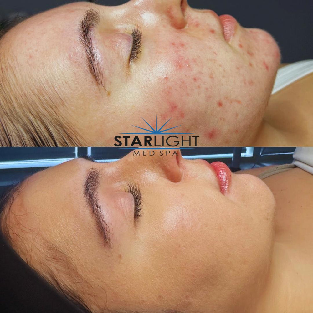 Before and after Active Acne Clearing