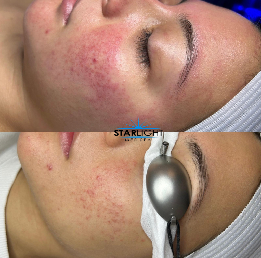 Photofacial Therapy at Starlight Med Spa